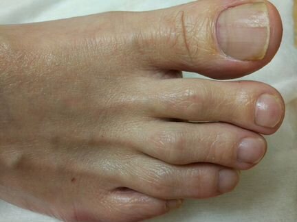 Педикюр медицинский. Подолог